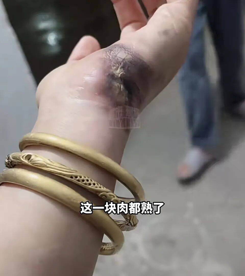 一瞬間手被燒熟，金手鐲被電碎！女子給電動車充電，不慎碰到充電口受傷:商貿